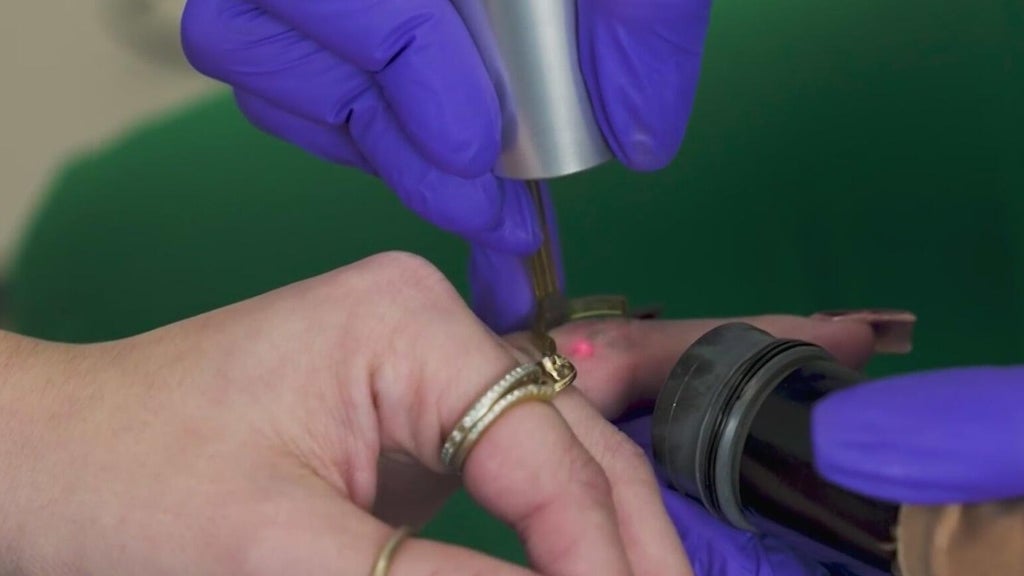 More South Florida tattoo clients are paying to get them removed — CBS Miami, Delray Beach Health news